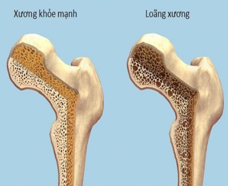Sâm đất ngăn ngừa và hỗ trợ bệnh loãng xương