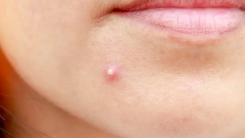 Hạt đu đủ làm giảm mụn trứng cá