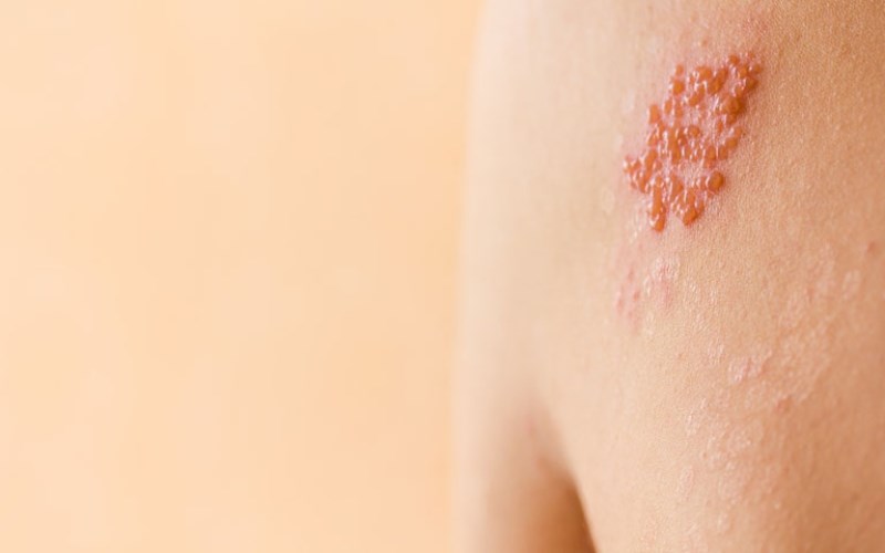 Với đặc tính chống viêm, lá ớt cũng sẽ giúp bạn chữa khỏi zona