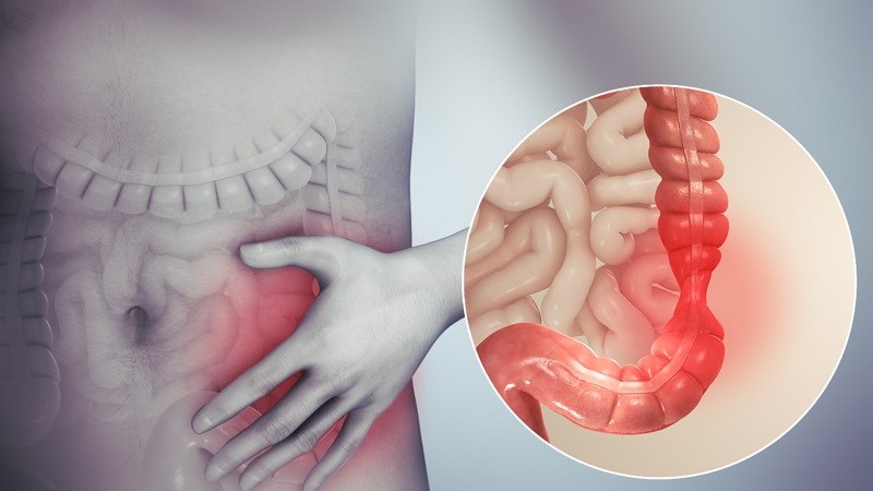 Cải thiện hội chứng ruột kích thích
