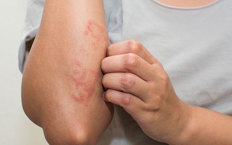 Lá tía tô giúp điều trị các bệnh ngoài da
