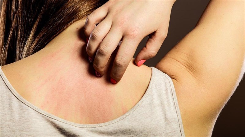 Hành tím làm dịu các triệu chứng dị ứng