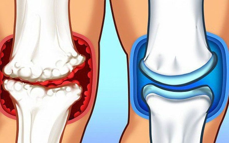 Hành tím giảm các triệu chứng của viêm khớp