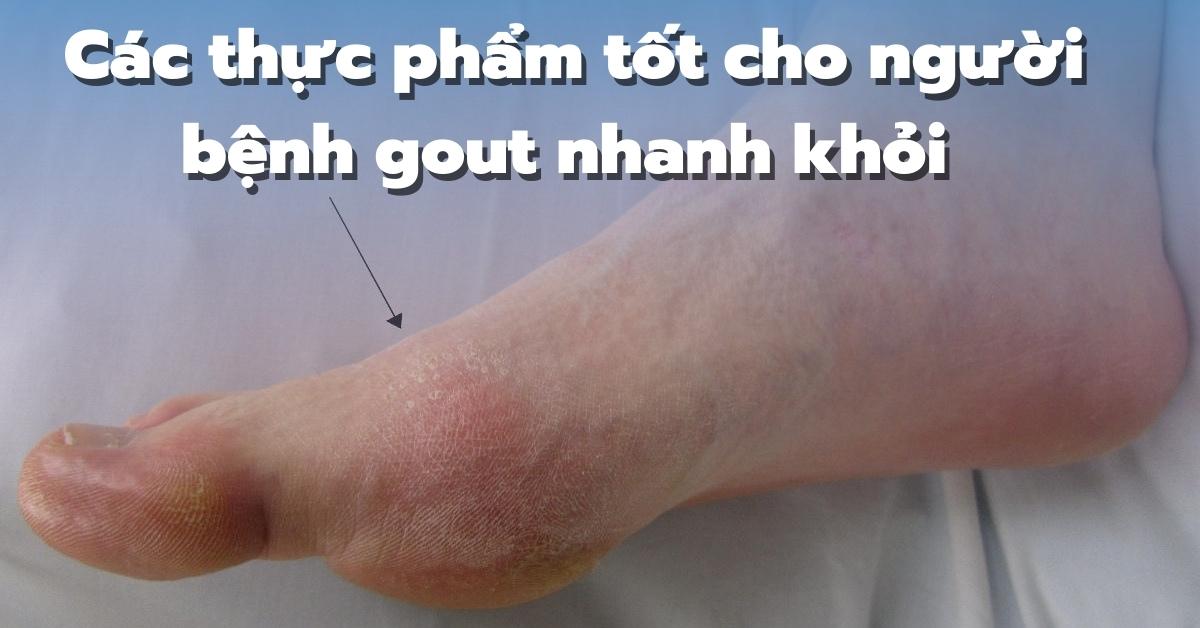 Các thực phẩm tốt cho người bệnh gout giúp cải thiện sức khỏe