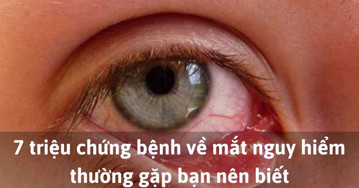 Các triệu chứng bệnh về mắt