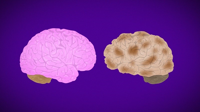 Kiểm soát bệnh Alzheimer