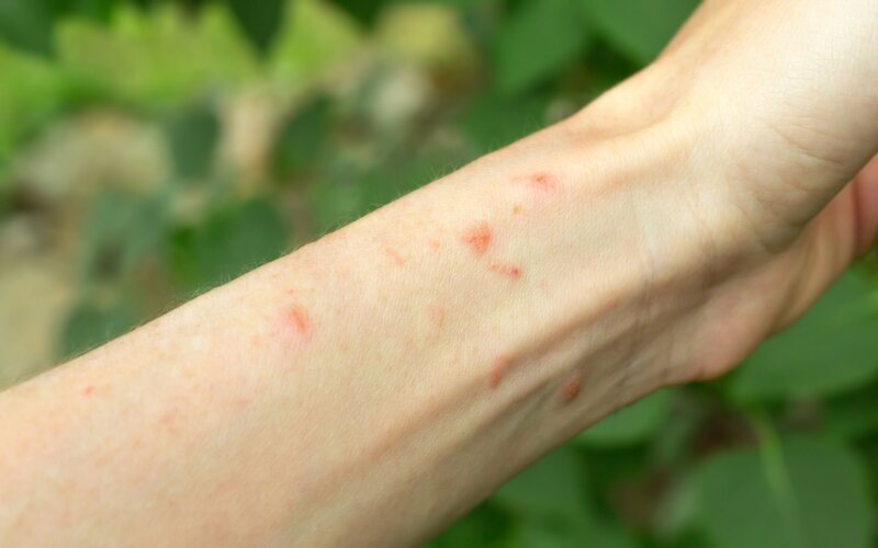 Giảm mề đay, mẩn ngứa