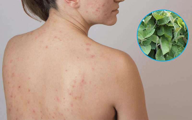 Lá mơ lông trị hiệu quả mụn ghẻ