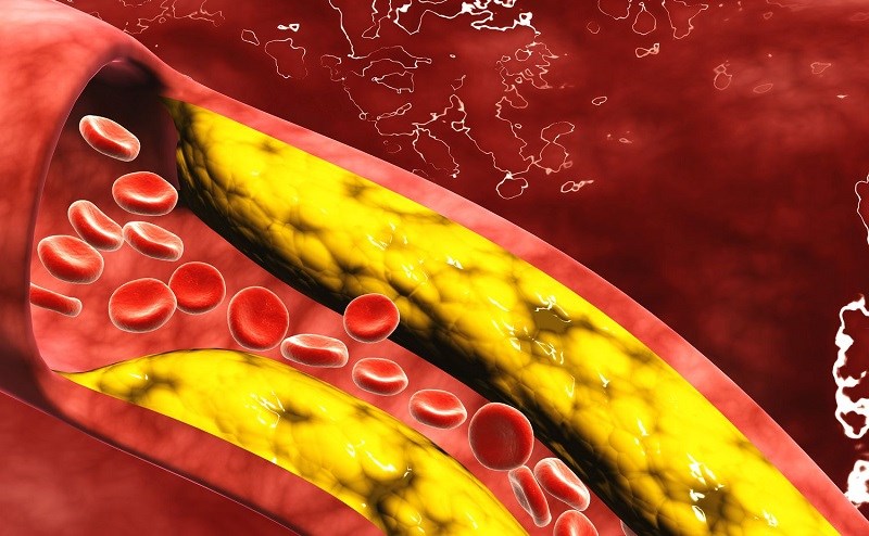 Tăng lượng cholesterol