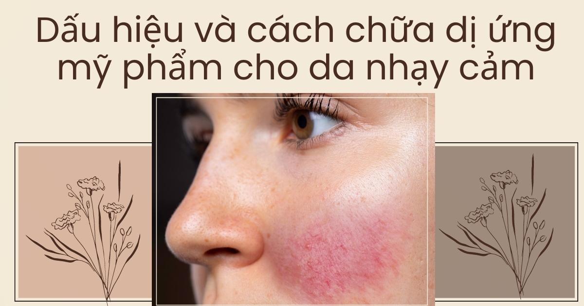 cách chữa dị ứng mỹ phẩm