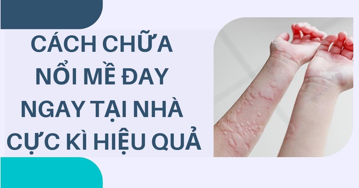 cách chữa mề đay