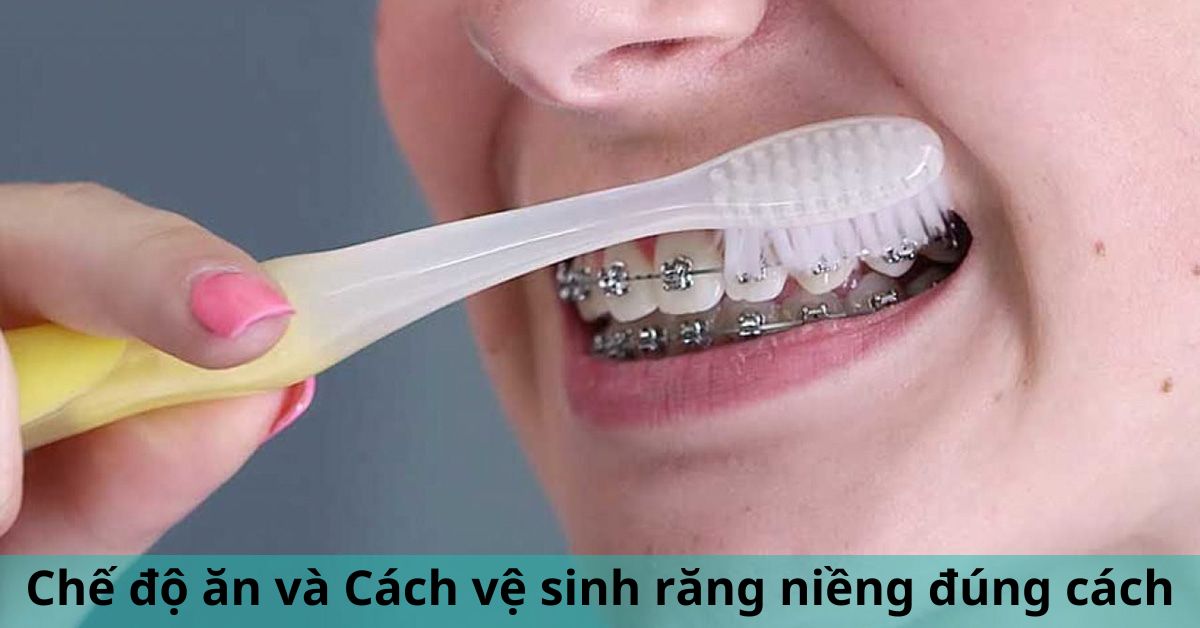 cách vệ sinh răng niềng