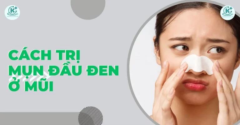 cách trị mụn đầu đen ở mũi