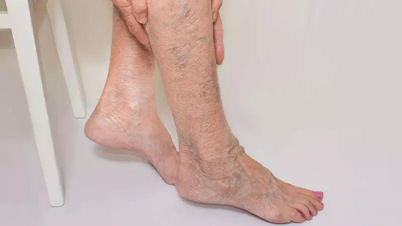 Suy giãn tĩnh mạch thường thấy ở tĩnh mạch nông của chân